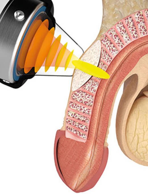 Shockwave Therapy for Peyronie s Disease in Coventry Central